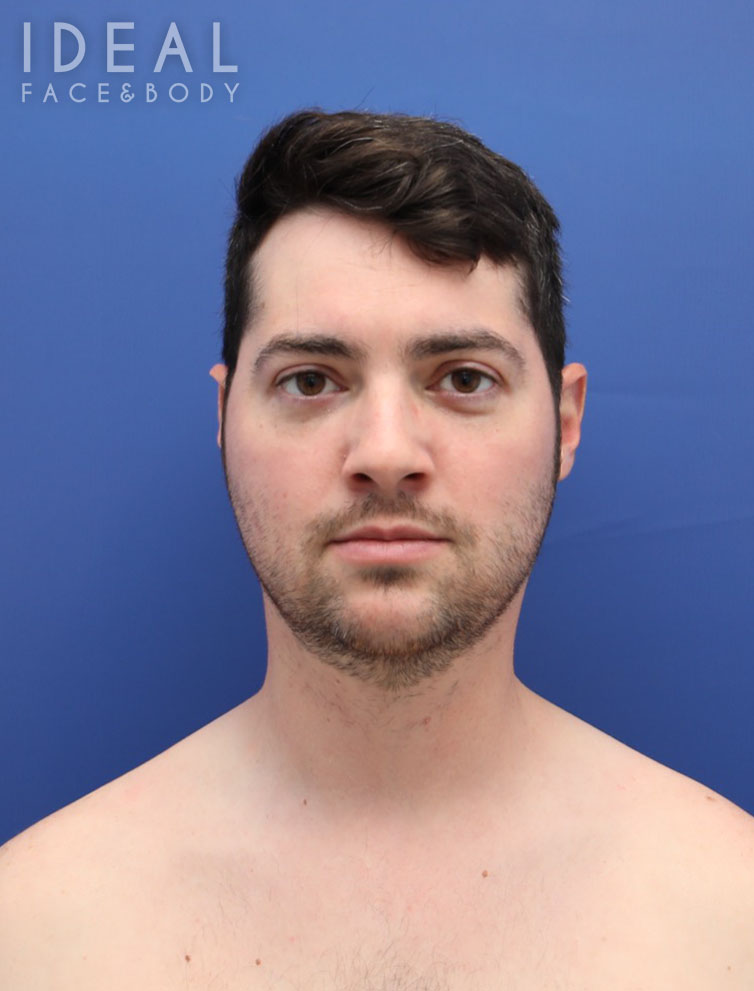 Before Image: Awake Chin, Neck, & Jawline Liposculpting | PRECISION SCULPT® - front