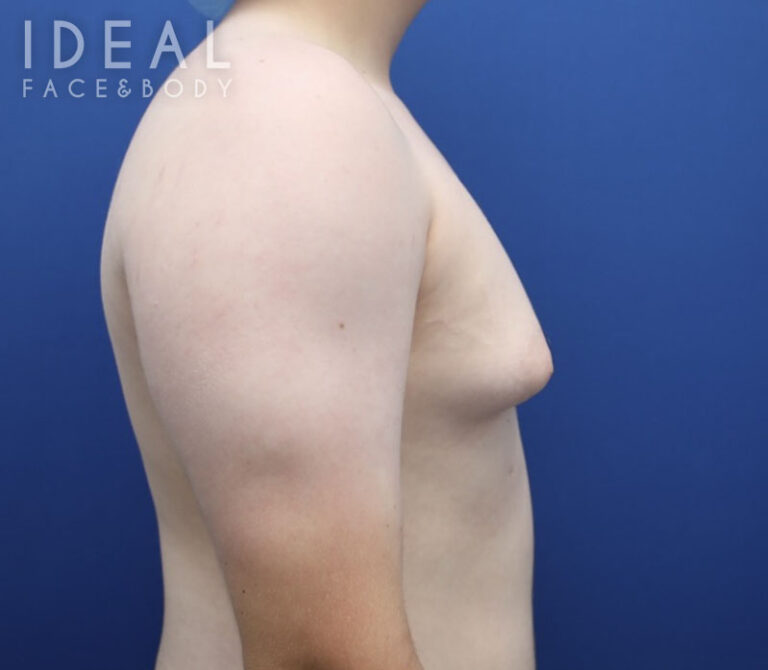 Before Image: Awake Male Chest Liposuction / Gynecomastia Surgery - right-side