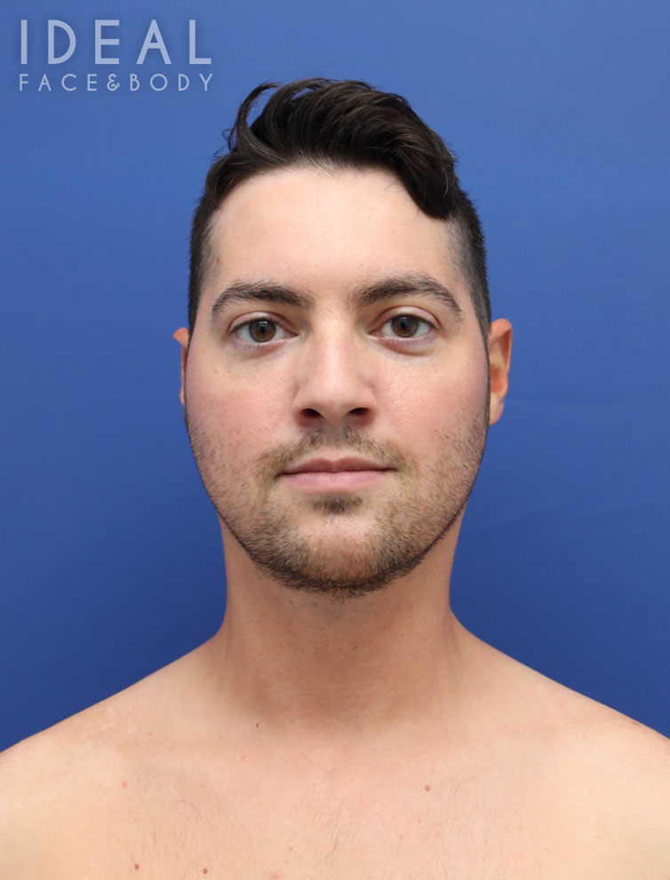 After Image: Awake Chin, Neck, & Jawline Liposculpting | PRECISION SCULPT® - front