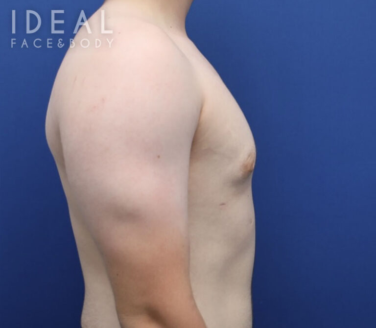 After Image: Awake Male Chest Liposuction / Gynecomastia Surgery - right-side