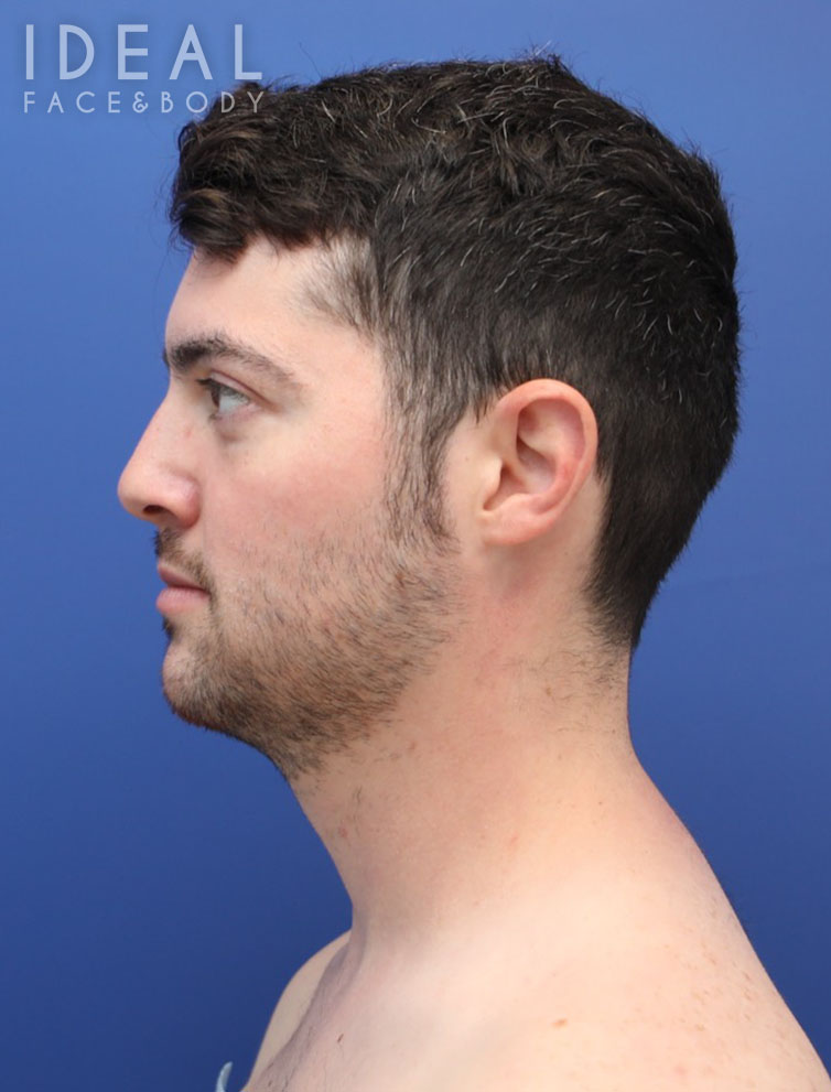 Before Image: Awake Chin, Neck, & Jawline Liposculpting | PRECISION SCULPT® - left-side