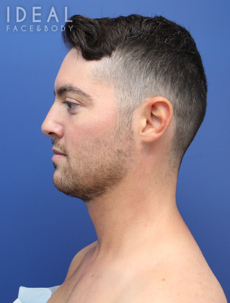 After Image: Awake Chin, Neck, & Jawline Liposculpting | PRECISION SCULPT® - left-side