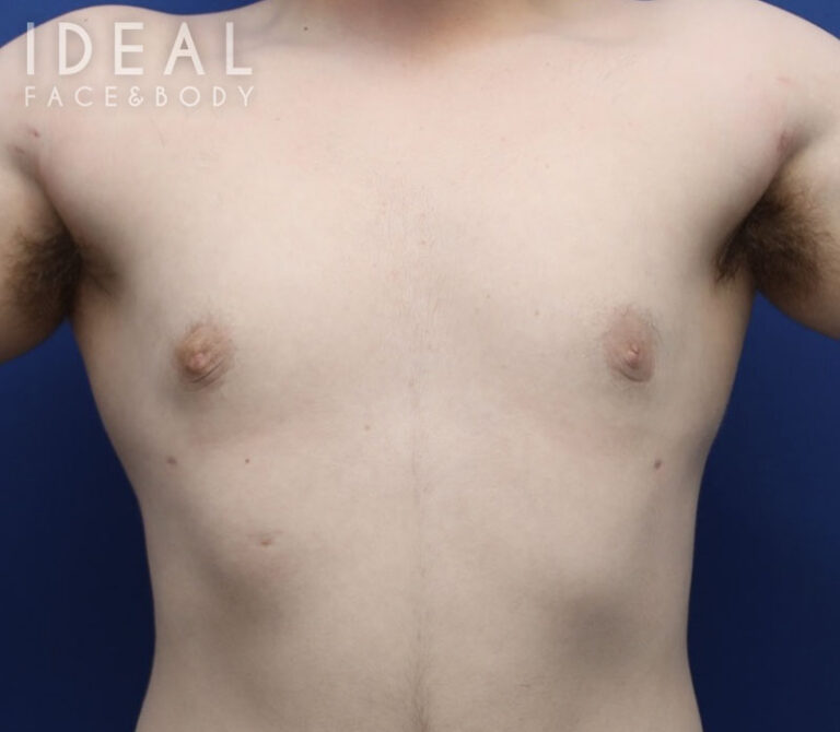 After Image: Awake Male Chest Liposuction / Gynecomastia Surgery - front