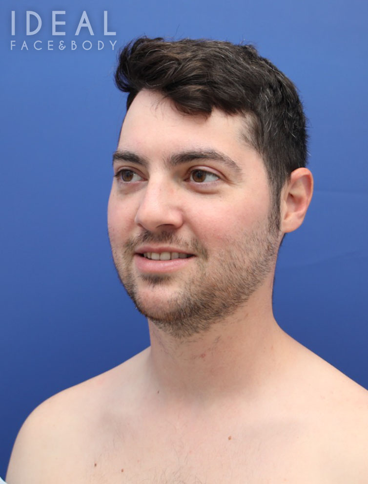 Before Image: Awake Chin, Neck, & Jawline Liposculpting | PRECISION SCULPT® - left-front-oblique