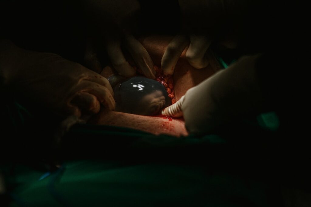 awake during surgery