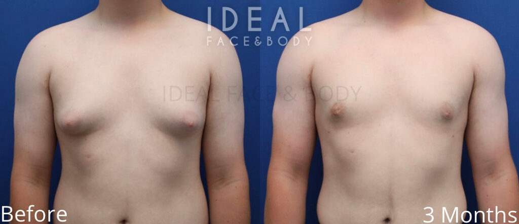 awake male chest sculpting before and after