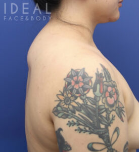 Before Image: Awake Buffalo Hump Removal | PRECISION SCULPT®