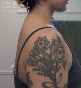 After Image: Awake Buffalo Hump Removal | PRECISION SCULPT®