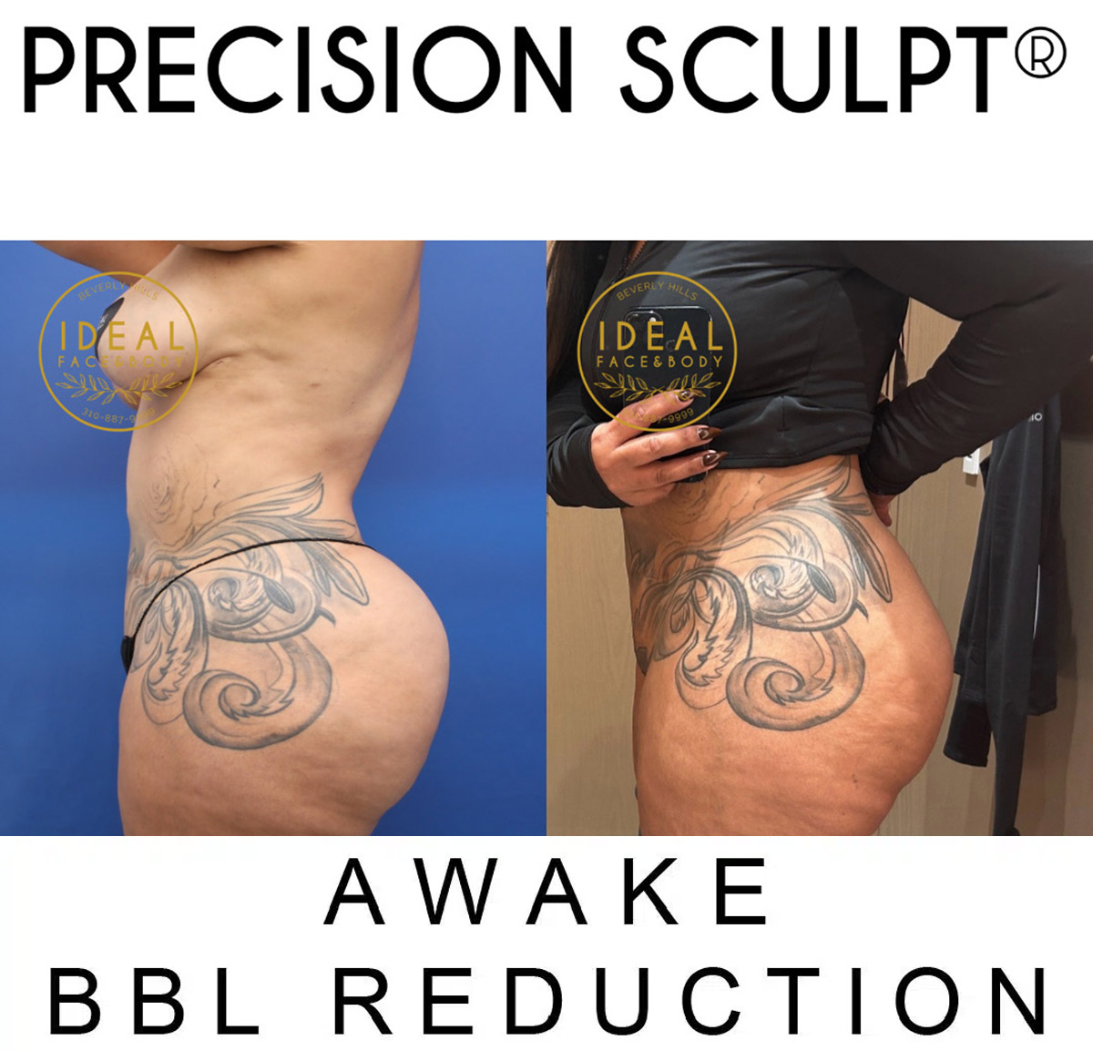 precision sculpt awake bbl reduction beverly hills dr justin yovino 2