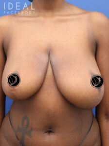 Before Image: Awake Breast Reduction Mammaplasty