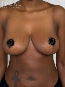 After Image: Awake Breast Reduction Mammaplasty