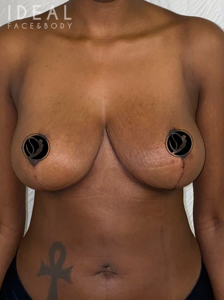 After Image: Awake Breast Reduction Mammaplasty - front
