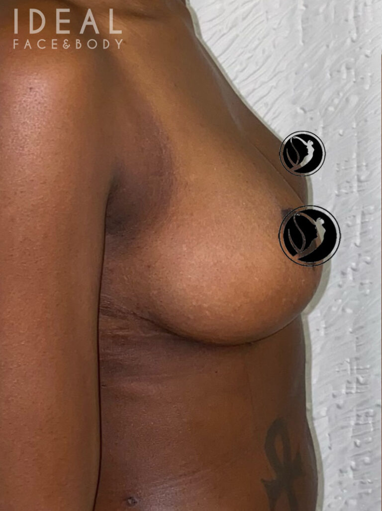 After Image: Awake Breast Reduction Mammaplasty - right-side