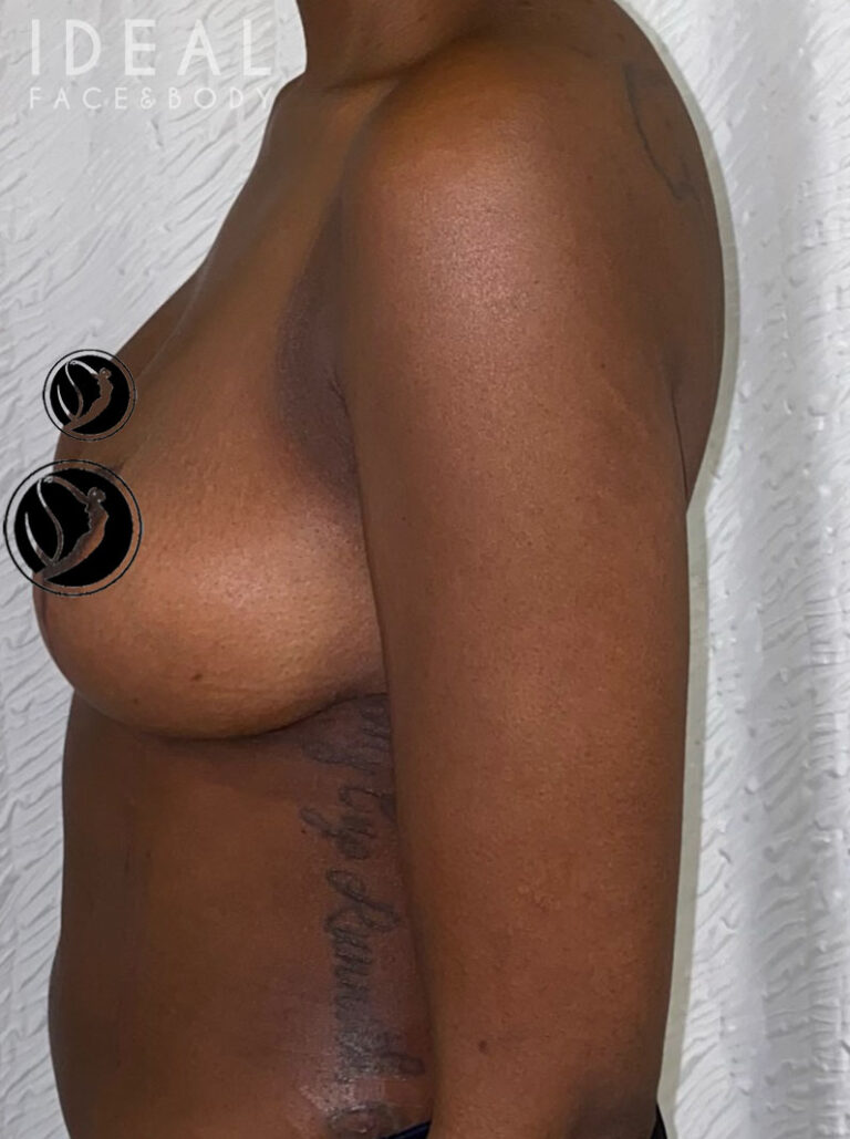 After Image: Awake Breast Reduction Mammaplasty - left-side
