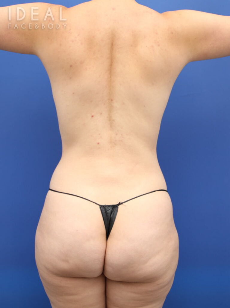 After Image: Awake 360 Liposuction | PRECISION SCULPT® - back