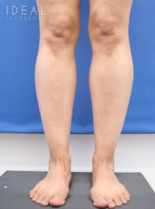 Before Image: Calves and Ankles | Awake Liposculpting | PRECISION SCULPT®