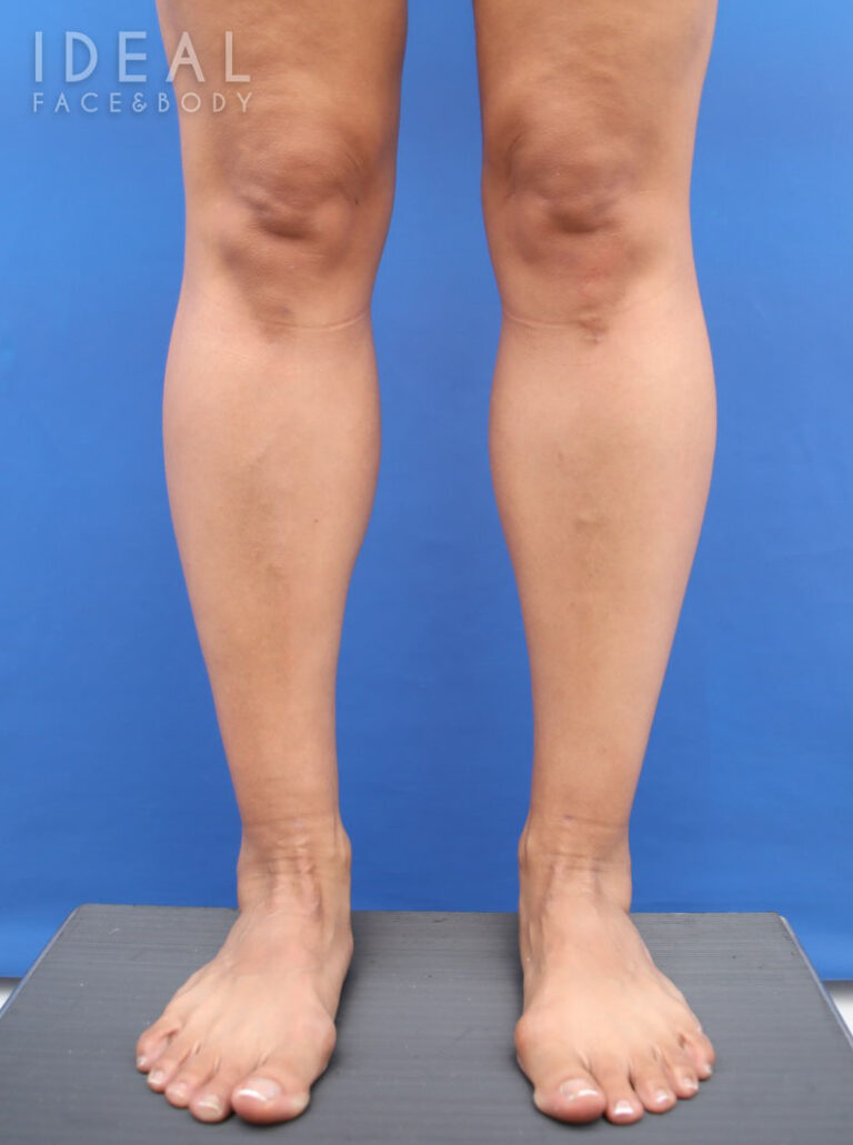 After Image: Calves and Ankles | Awake Liposculpting | PRECISION SCULPT® - front