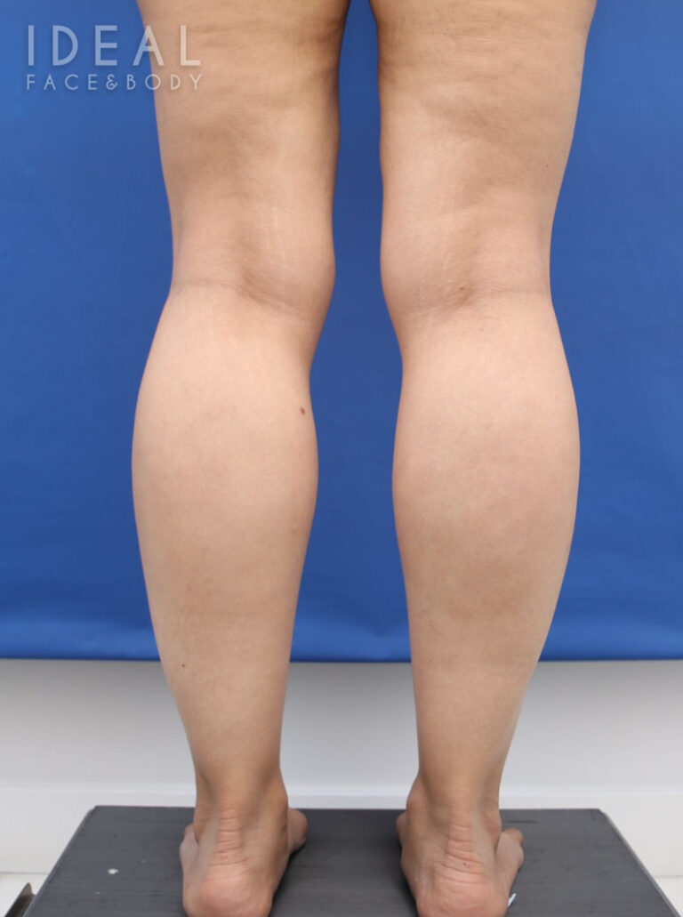 Before Image: Calves and Ankles | Awake Liposculpting | PRECISION SCULPT® - back