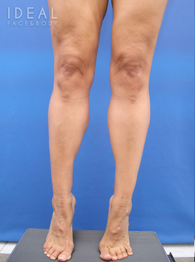 After Image: Calves and Ankles | Awake Liposculpting | PRECISION SCULPT® - front