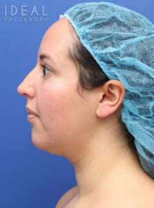 Before Image: Awake Chin, Neck, & Jawline Liposculpting | PRECISION SCULPT®