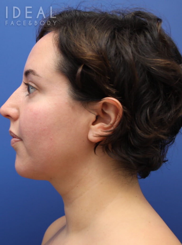 After Image: Awake Chin, Neck, & Jawline Liposculpting | PRECISION SCULPT® - left-side
