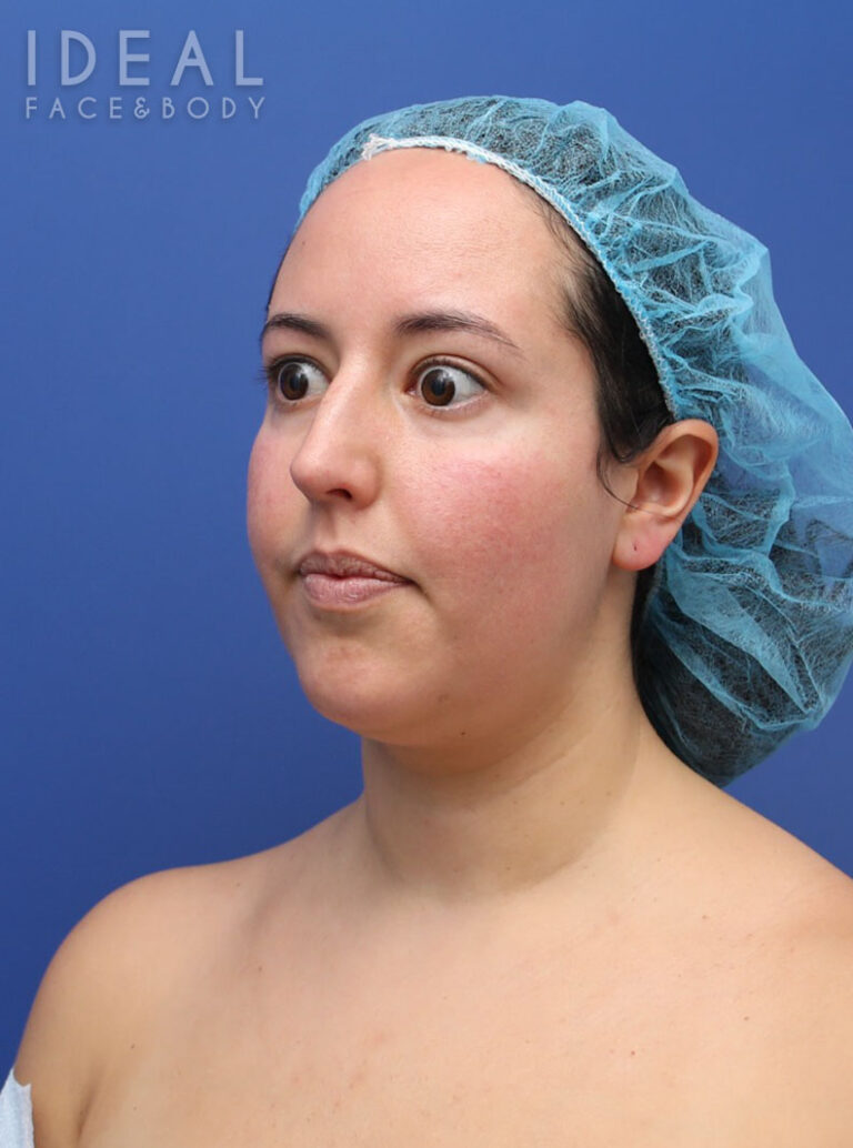 Before Image: Awake Chin, Neck, & Jawline Liposculpting | PRECISION SCULPT® - left-front-oblique