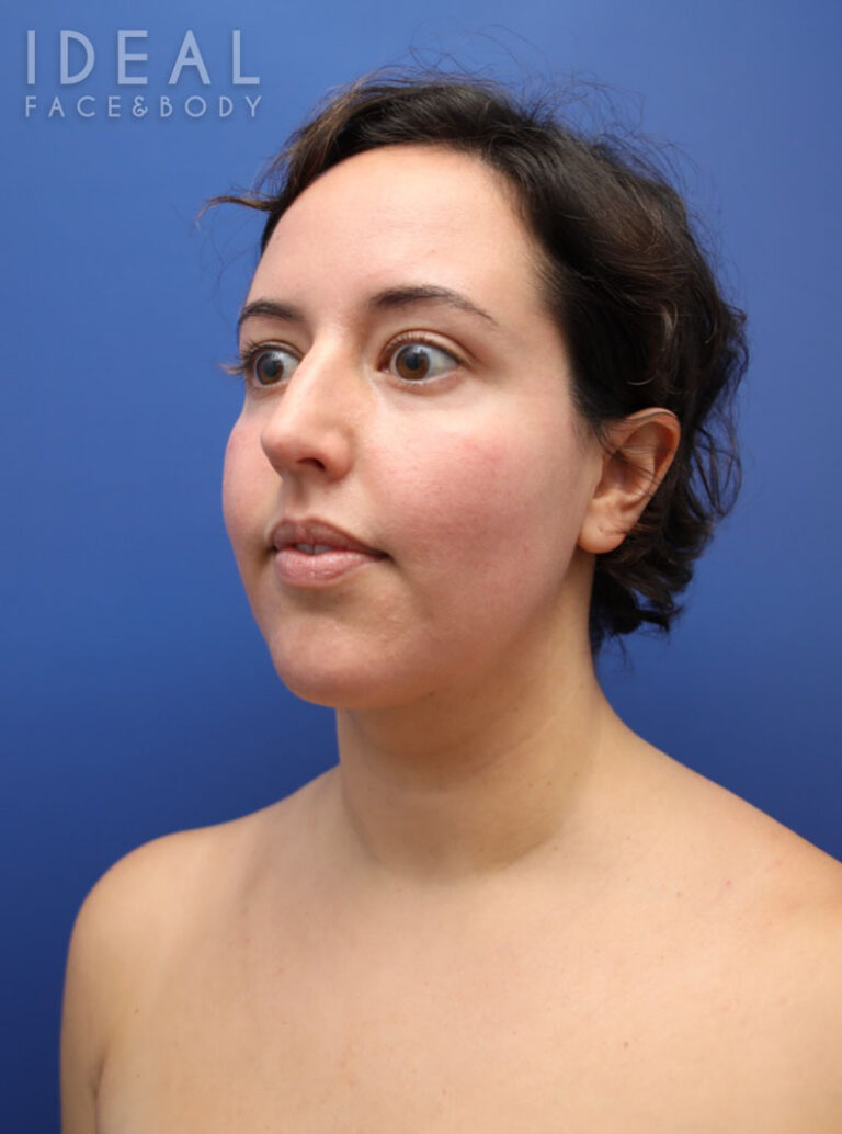 After Image: Awake Chin, Neck, & Jawline Liposculpting | PRECISION SCULPT® - left-front-oblique
