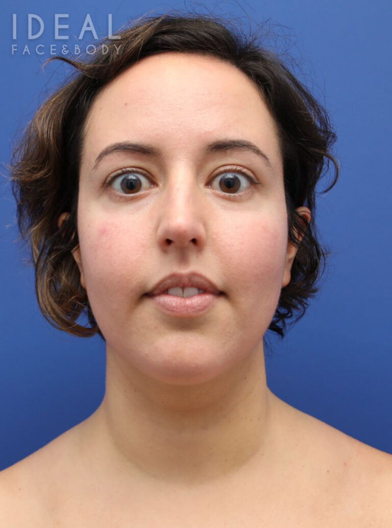 After Image: Awake Chin, Neck, & Jawline Liposculpting | PRECISION SCULPT® - front