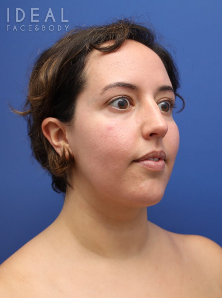 After Image: Awake Chin, Neck, & Jawline Liposculpting | PRECISION SCULPT® - right-front-oblique