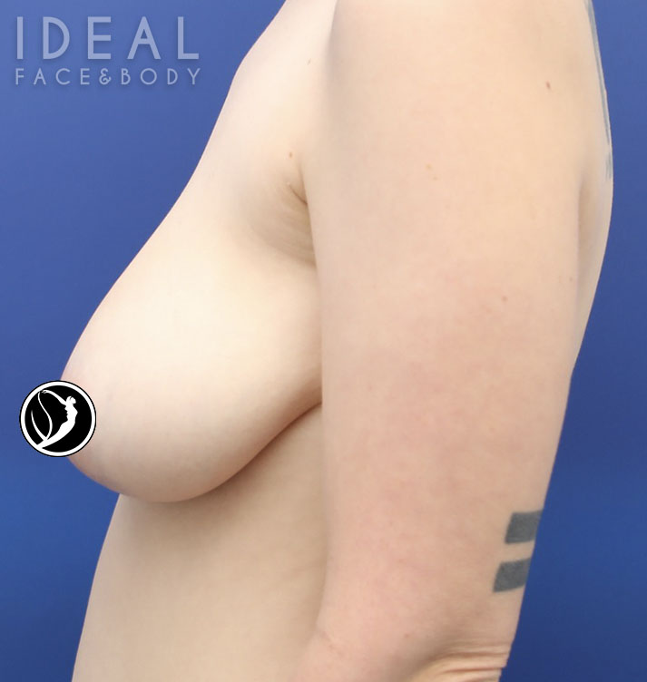 Before Image: Awake Breast Lift® | Mastopexy | Reduction - left-side