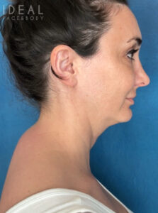 Before Image: Awake Buffalo Hump Removal | PRECISION SCULPT®