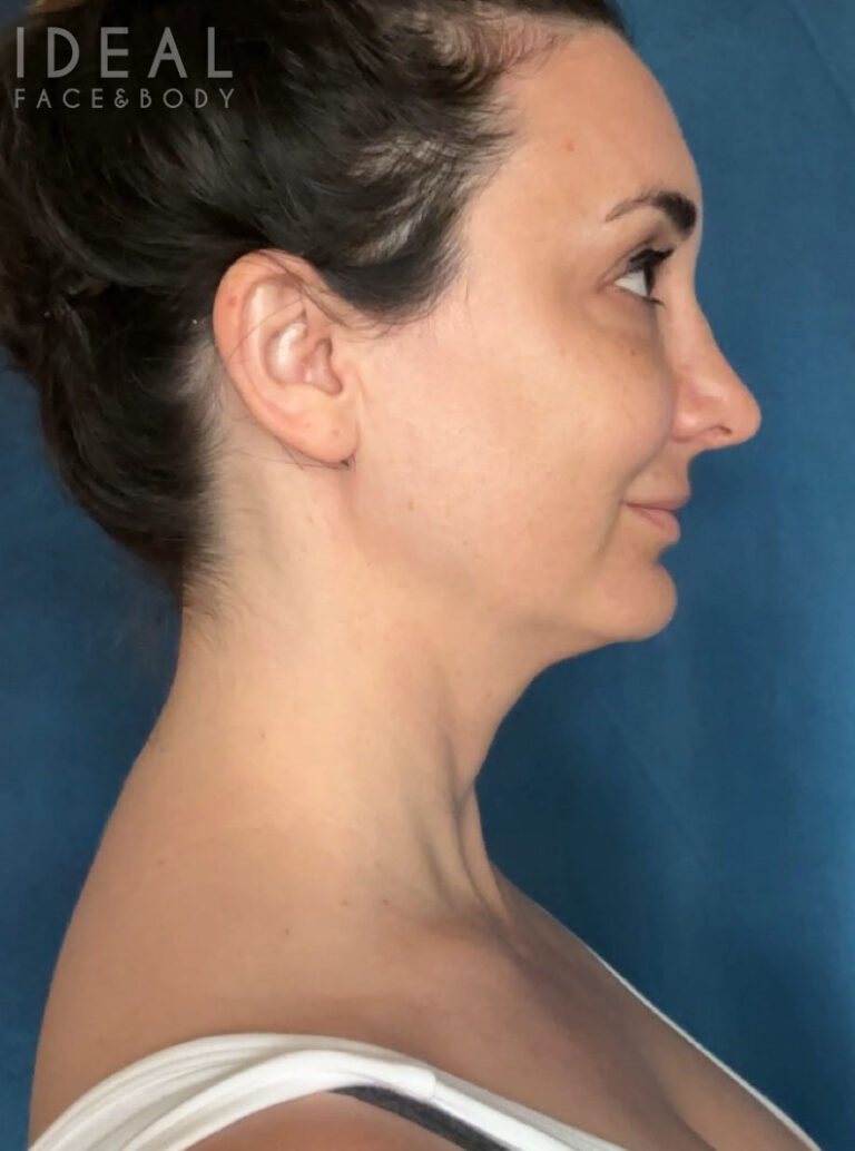 After Image: Awake Buffalo Hump Removal | PRECISION SCULPT® - right-side