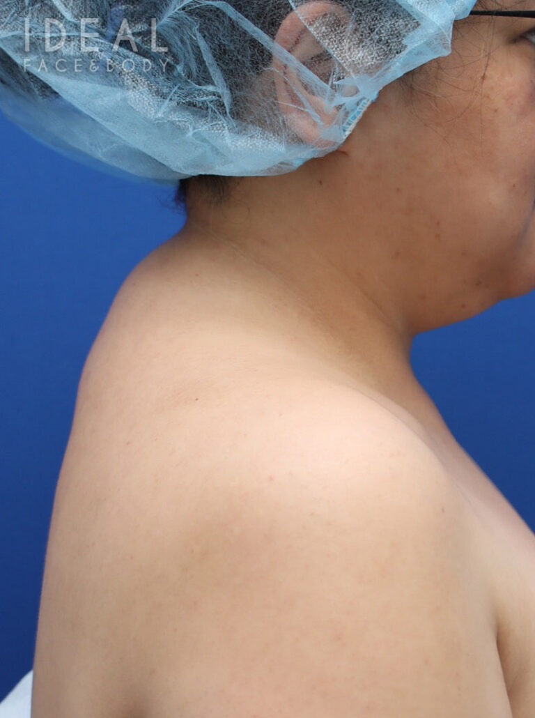 Before Image: Awake Buffalo Hump Removal | PRECISION SCULPT® - right-side