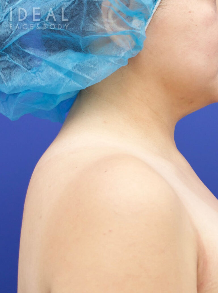 After Image: Awake Buffalo Hump Removal | PRECISION SCULPT® - right-side