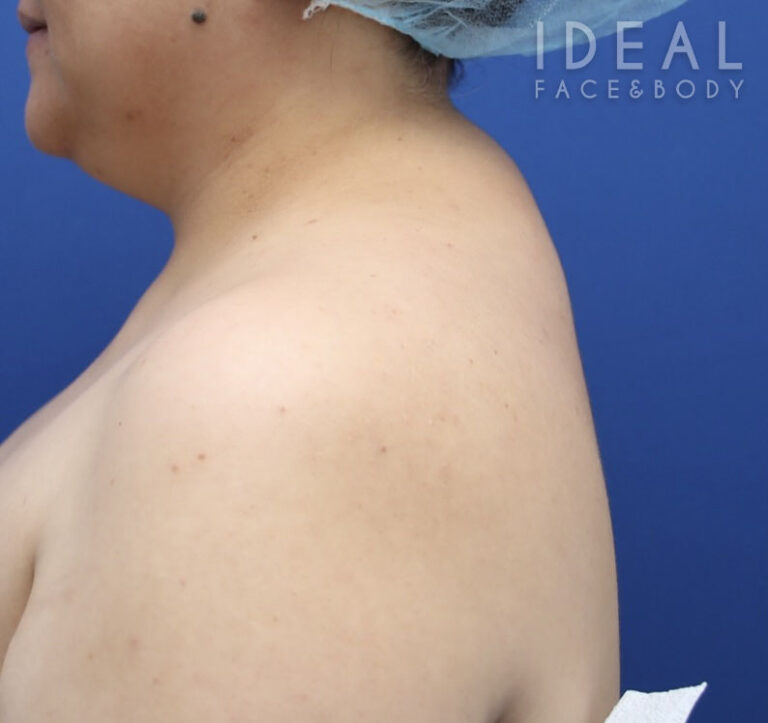 Before Image: Awake Buffalo Hump Removal | PRECISION SCULPT® - left-side