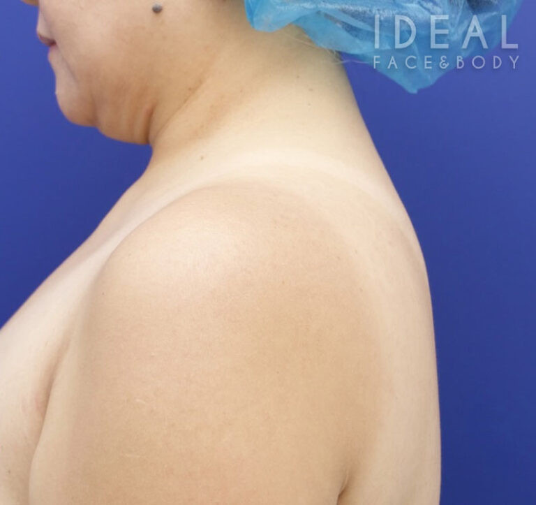 After Image: Awake Buffalo Hump Removal | PRECISION SCULPT® - left-side