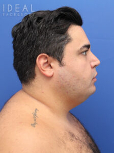 Before Image: Awake Chin, Neck, & Jawline Liposculpting | PRECISION SCULPT®