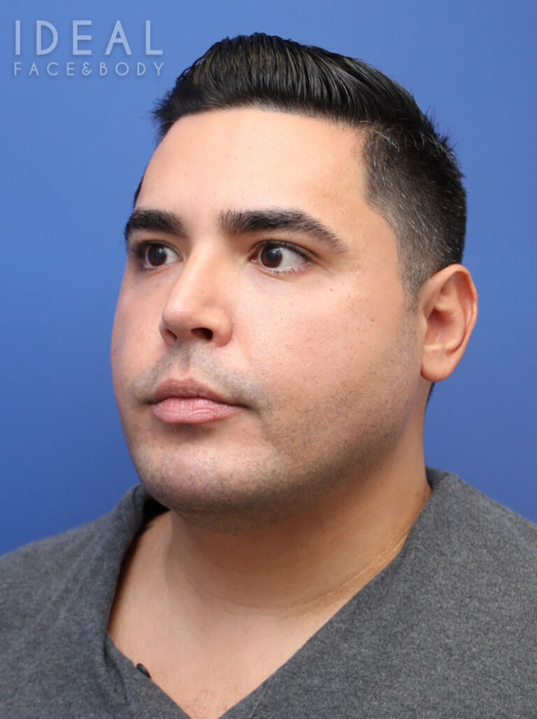 After Image: Awake Chin, Neck, & Jawline Liposculpting | PRECISION SCULPT® - left-front-oblique