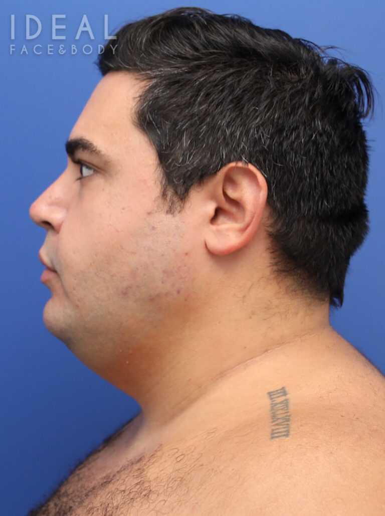 Before Image: Awake Chin, Neck, & Jawline Liposculpting | PRECISION SCULPT® - left-side
