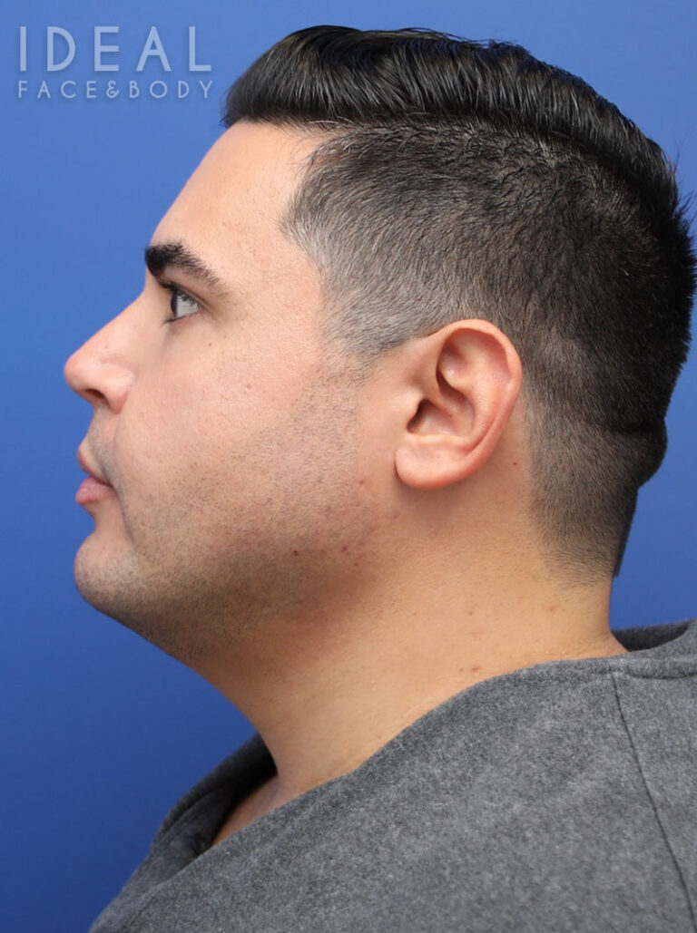 After Image: Awake Chin, Neck, & Jawline Liposculpting | PRECISION SCULPT® - left-side