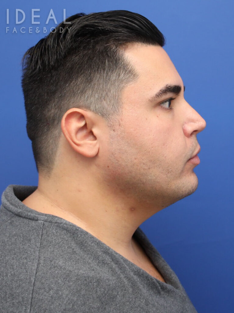 After Image: Awake Chin, Neck, & Jawline Liposculpting | PRECISION SCULPT® - right-side
