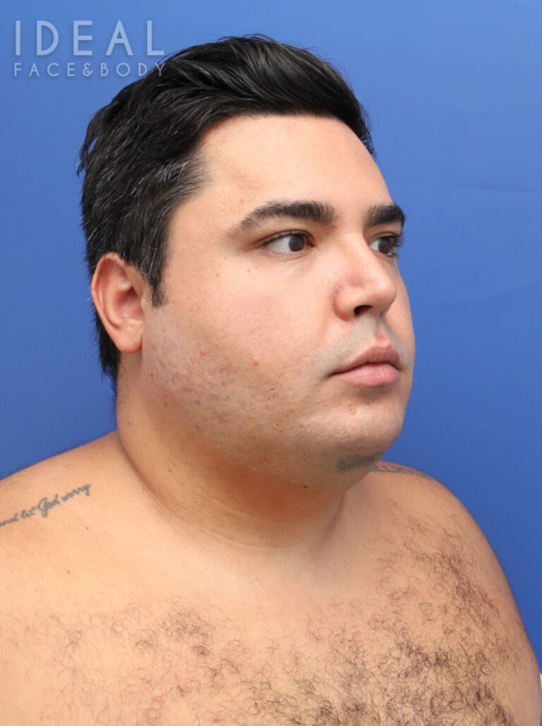 Before Image: Awake Chin, Neck, & Jawline Liposculpting | PRECISION SCULPT® - right-front-oblique