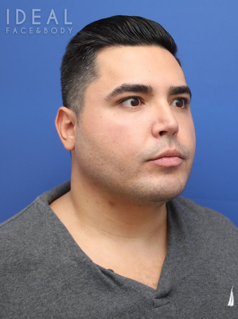 After Image: Awake Chin, Neck, & Jawline Liposculpting | PRECISION SCULPT® - right-front-oblique