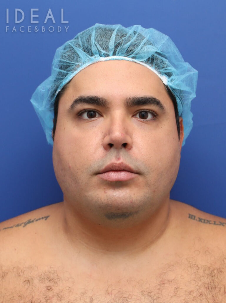 Before Image: Awake Chin, Neck, & Jawline Liposculpting | PRECISION SCULPT® - front