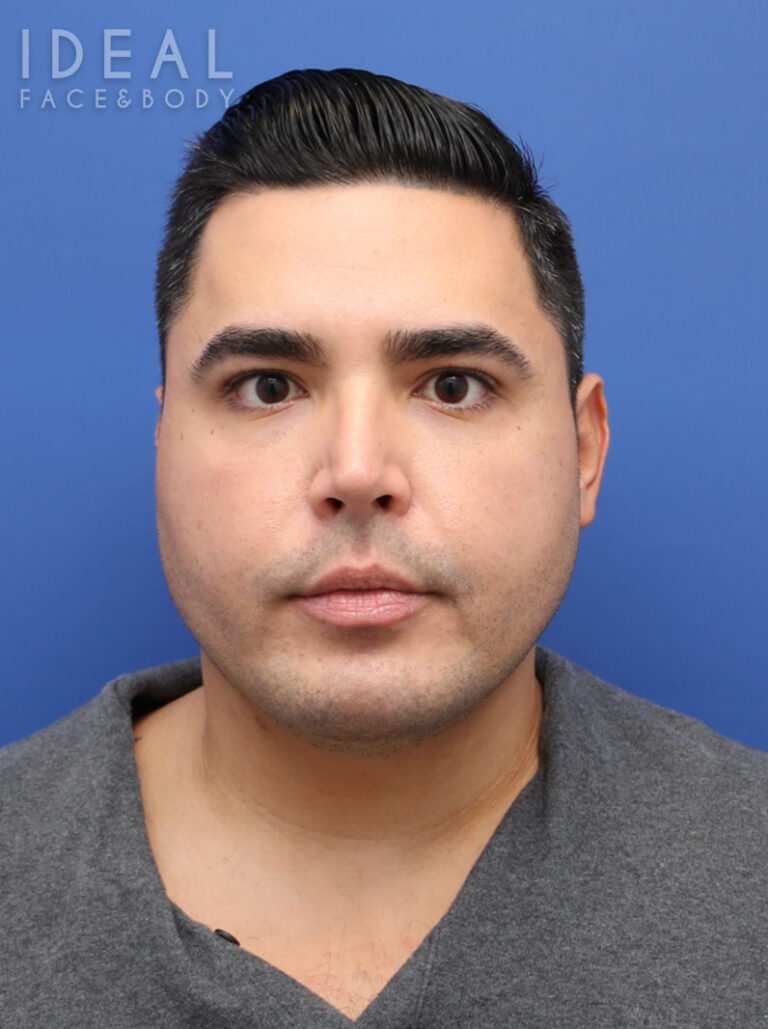 After Image: Awake Chin, Neck, & Jawline Liposculpting | PRECISION SCULPT® - front