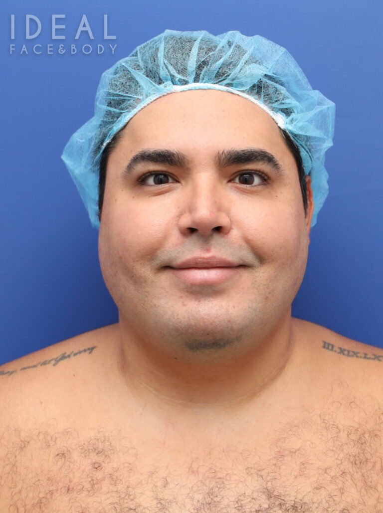 Before Image: Awake Chin, Neck, & Jawline Liposculpting | PRECISION SCULPT® - front