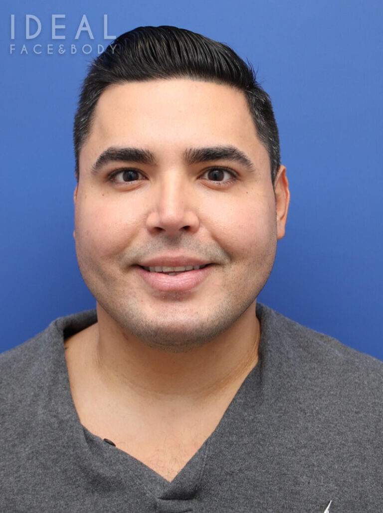 After Image: Awake Chin, Neck, & Jawline Liposculpting | PRECISION SCULPT® - front