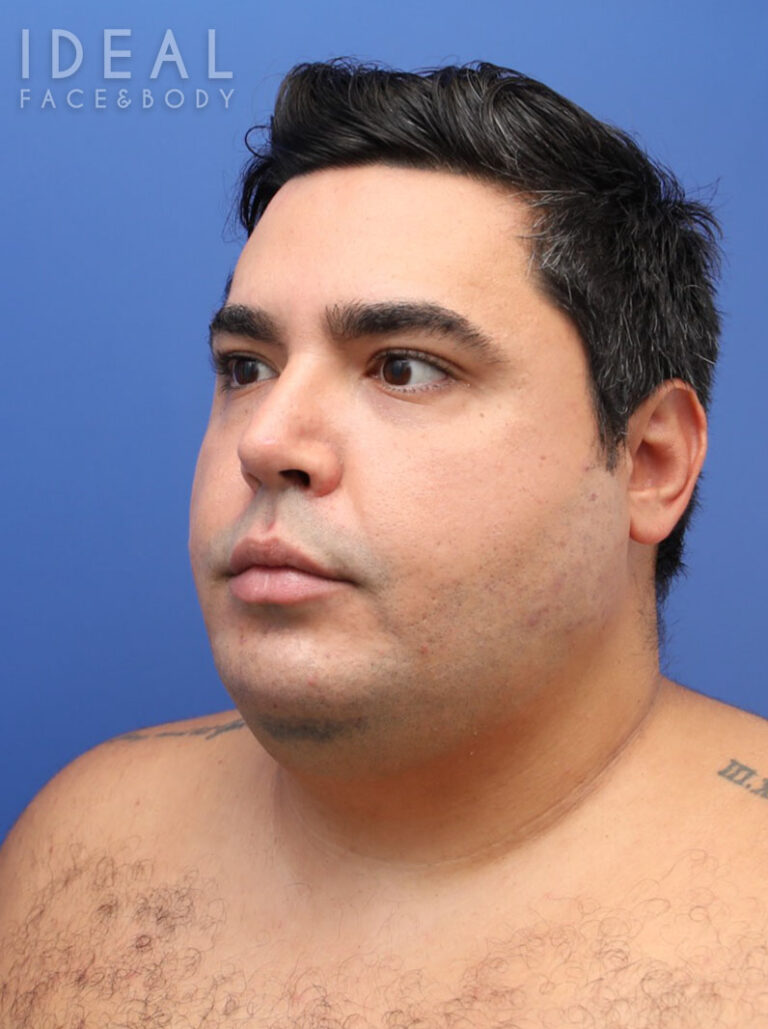 Before Image: Awake Chin, Neck, & Jawline Liposculpting | PRECISION SCULPT® - left-front-oblique