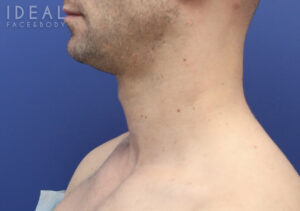 Before Image: Awake Chin, Neck Liposculpting | PRECISION SCULPT® | Male