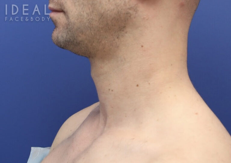 Before Image: Awake Chin, Neck Liposculpting | PRECISION SCULPT® | Male - left-side